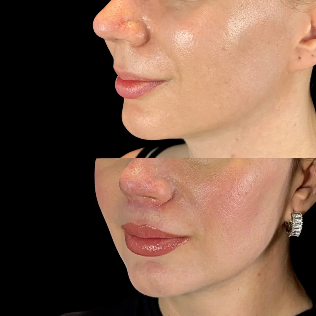 LipLift — öncesi ve sonrası