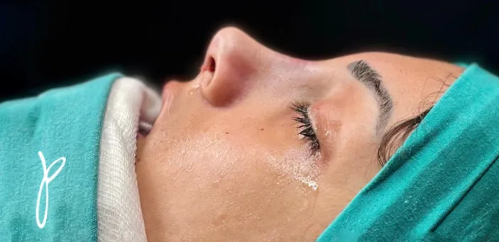 Burun estetiği — sonrası