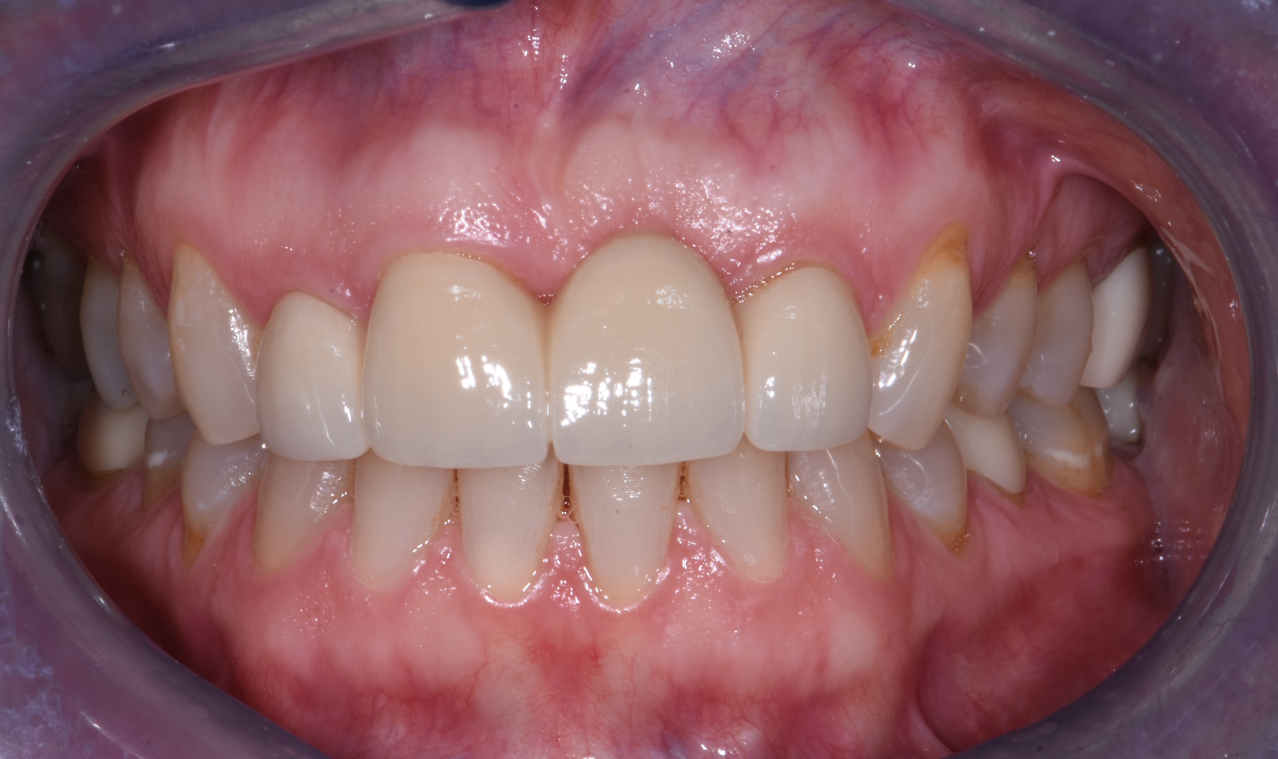 Patient smile after dental implant treatment