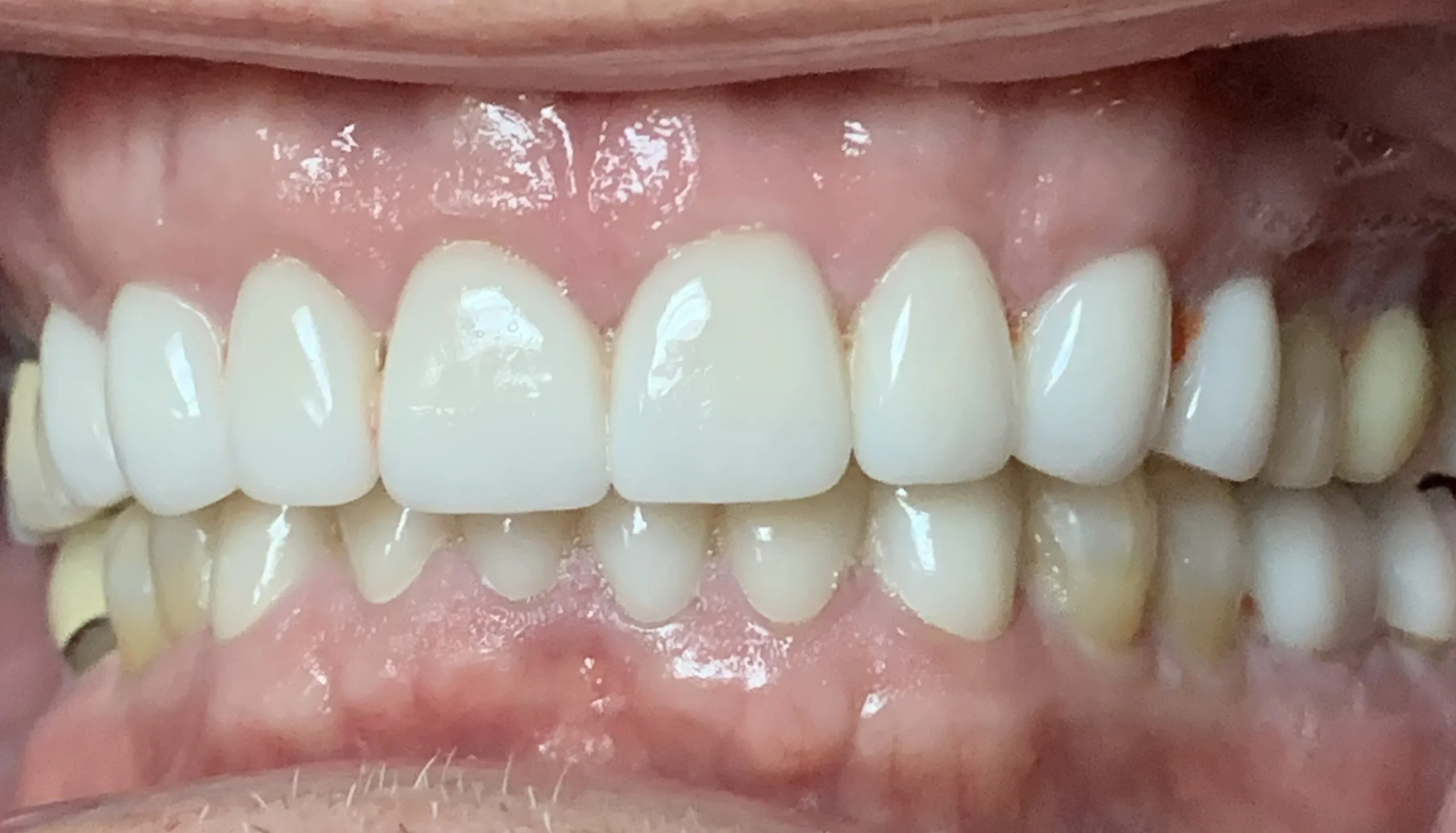 Patient smile after dental implant treatment