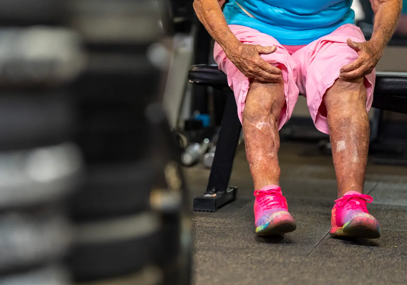 senior woman showing legs damaged from car accident