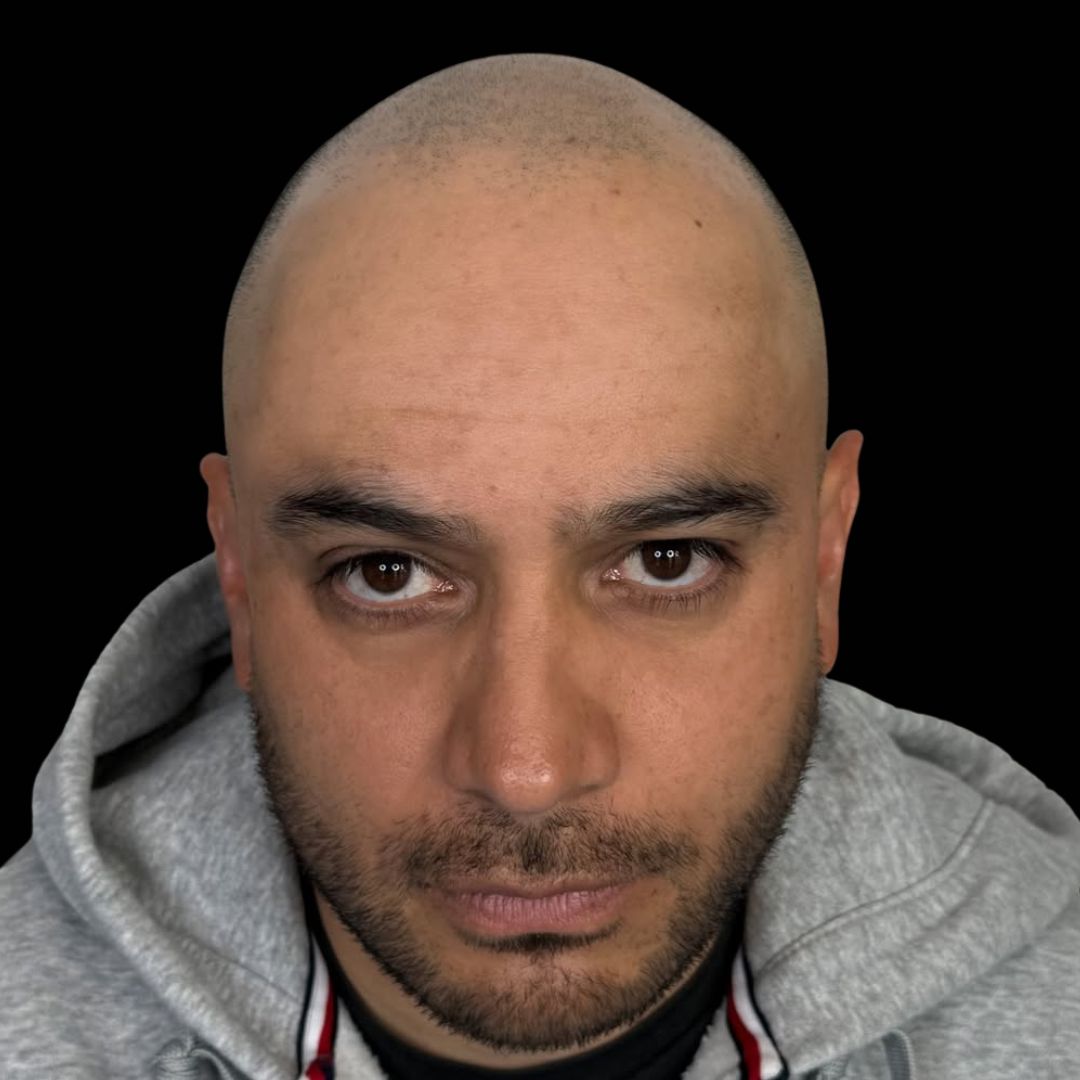 Cuero cabelludo con alopecia antes de la micropigmentación capilar