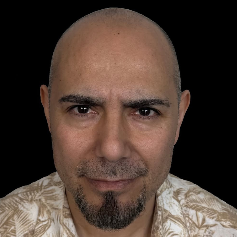 Cuero cabelludo con alopecia antes de la micropigmentación capilar