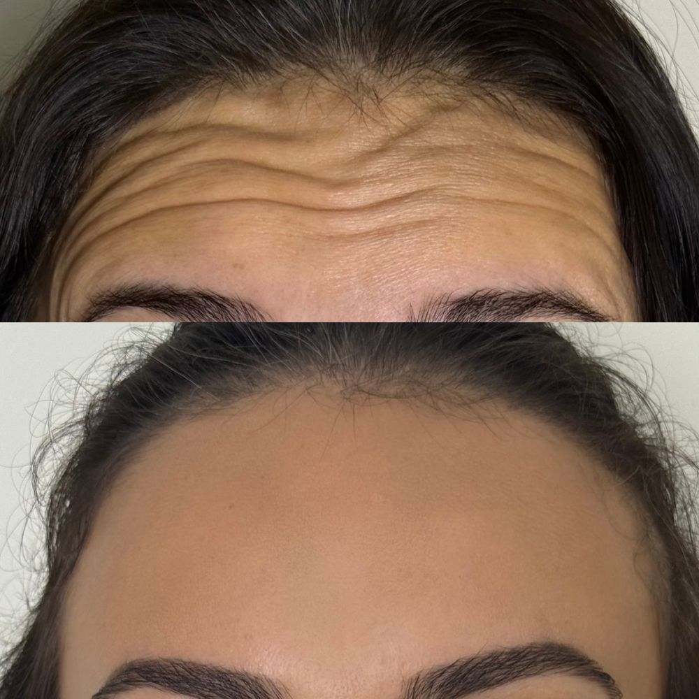 Before and after tox treatment