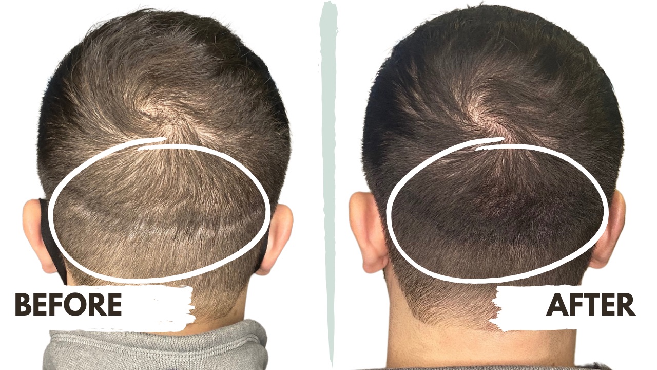 Scalp micropigmentation before and after – back view of a man's head showing a natural-looking hair density enhancement, blending seamlessly with existing hair after treatment.