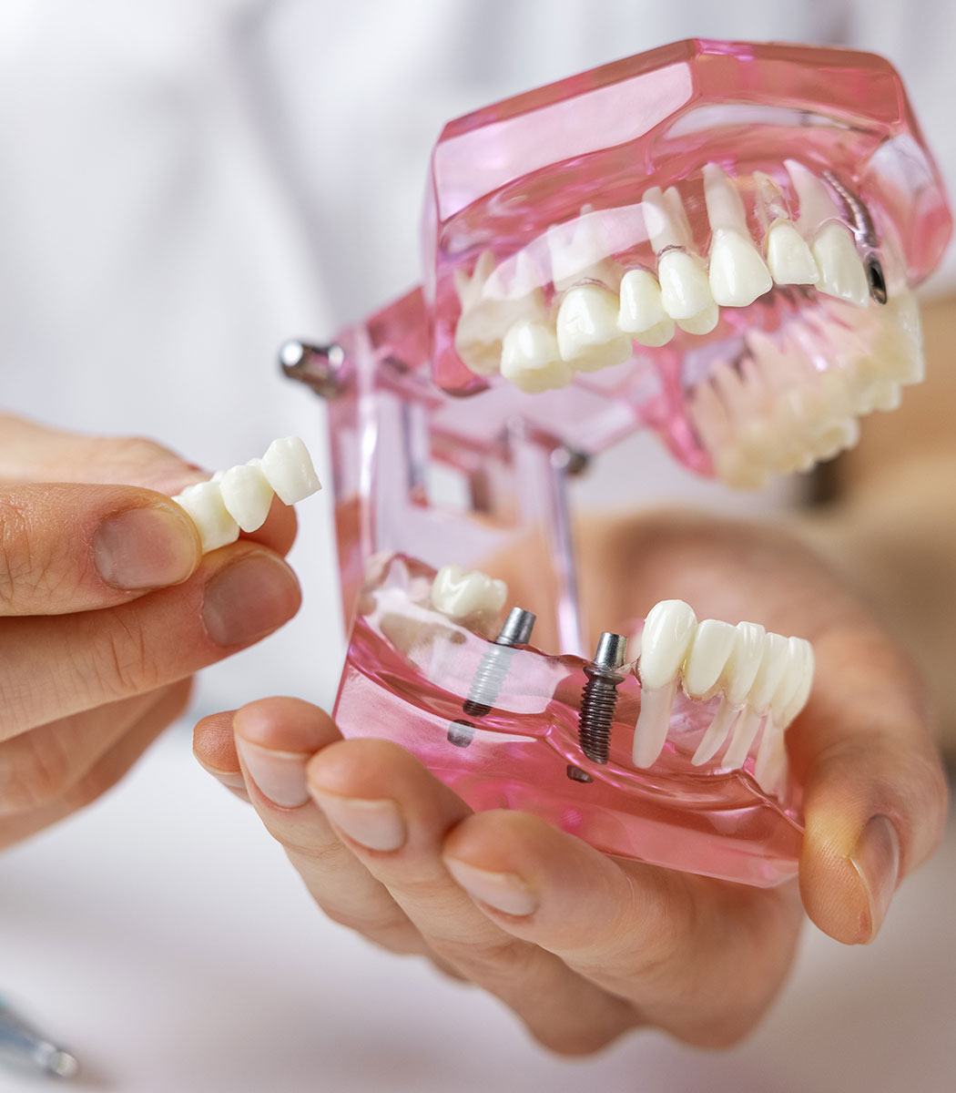 Traditional Braces