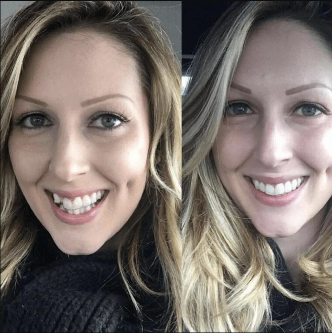 beforeafter-orthotreatment