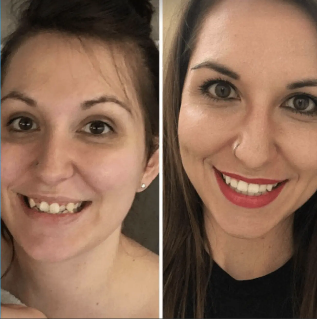 beforeafter-orthotreatment