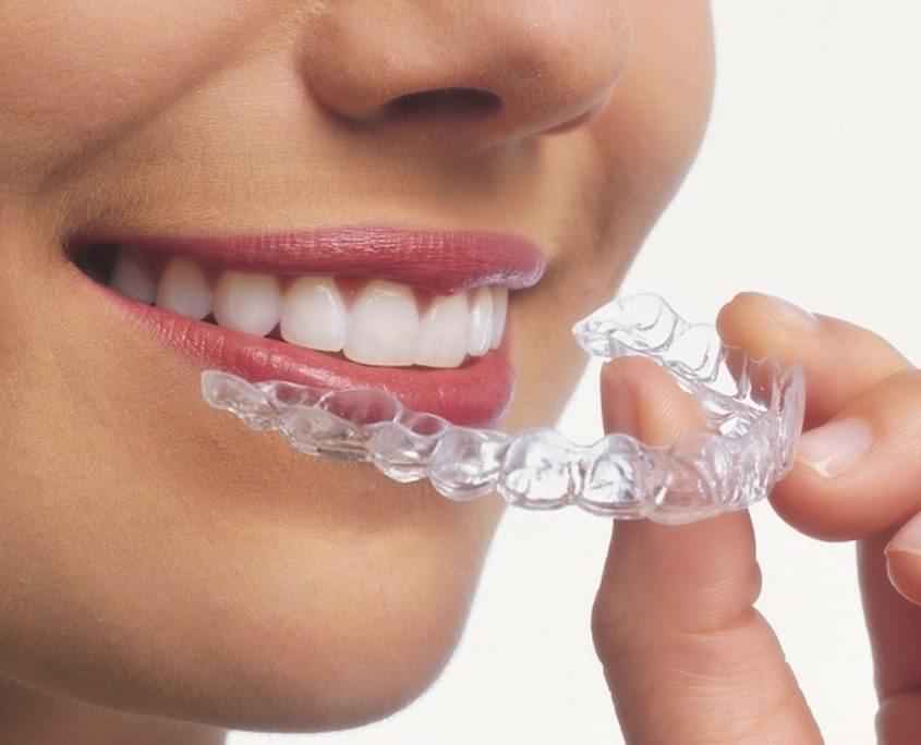 invisalign