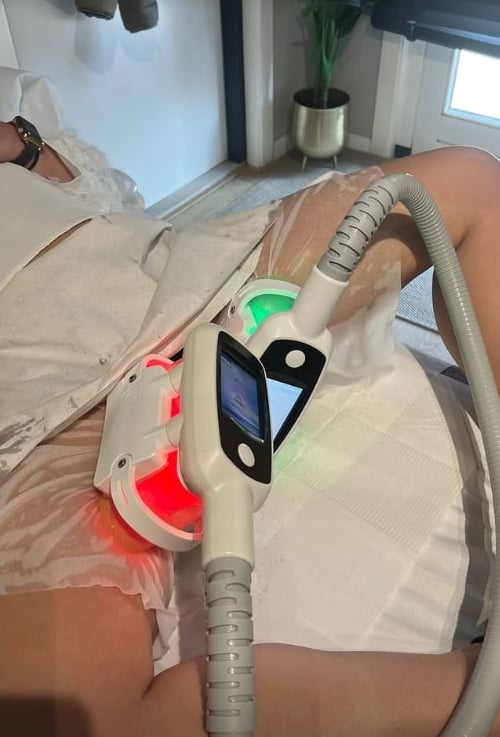 Cryolipolyse behandeling Beauty Trendz Almere