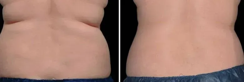 Cryolipolyse resultaat voor en na