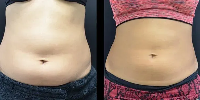 Cryolipolyse resultaat voor en na