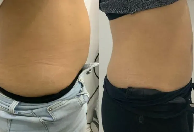 Cryolipolyse resultaat voor en na