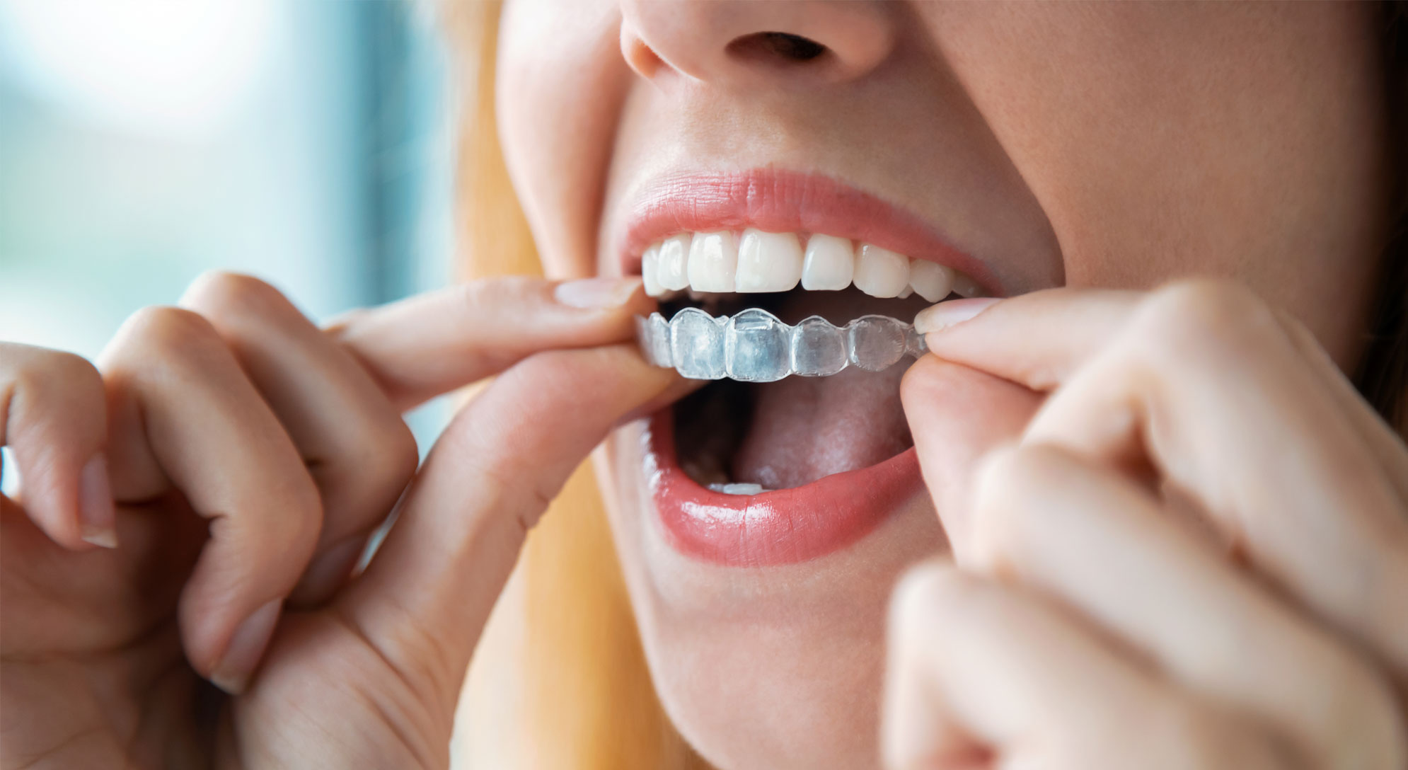 Woman holding invisalign