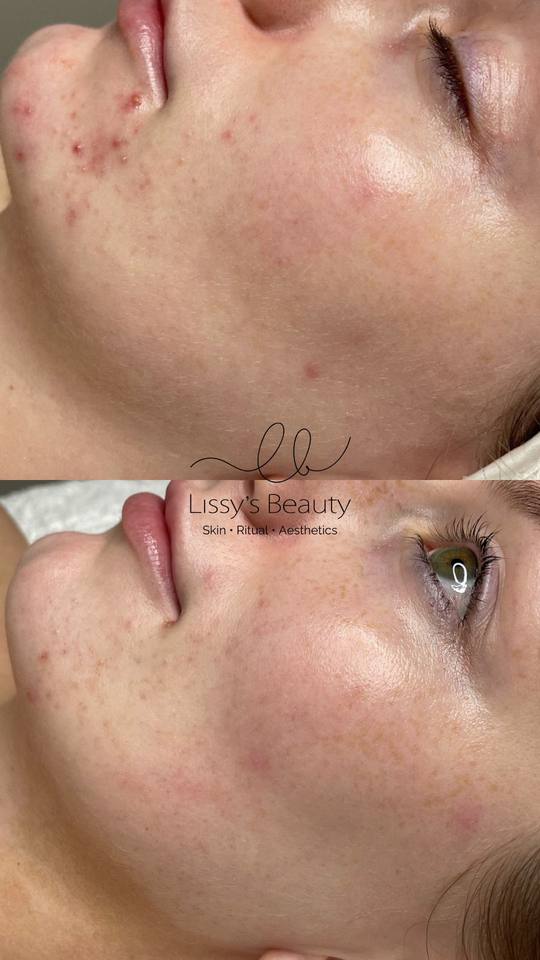 Client skin progress 14