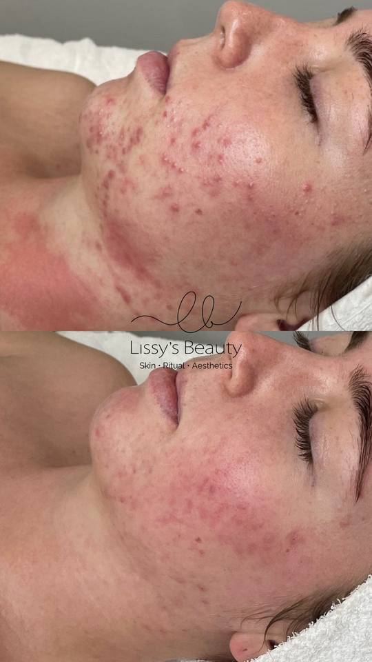 Client skin progress 3