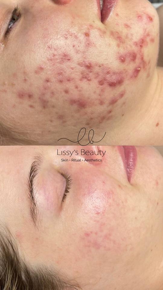 Client skin progress 13