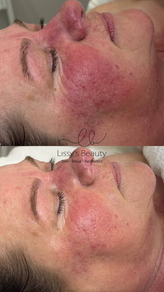 Client skin progress 1