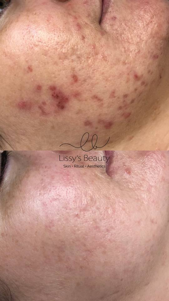 Client skin progress 15