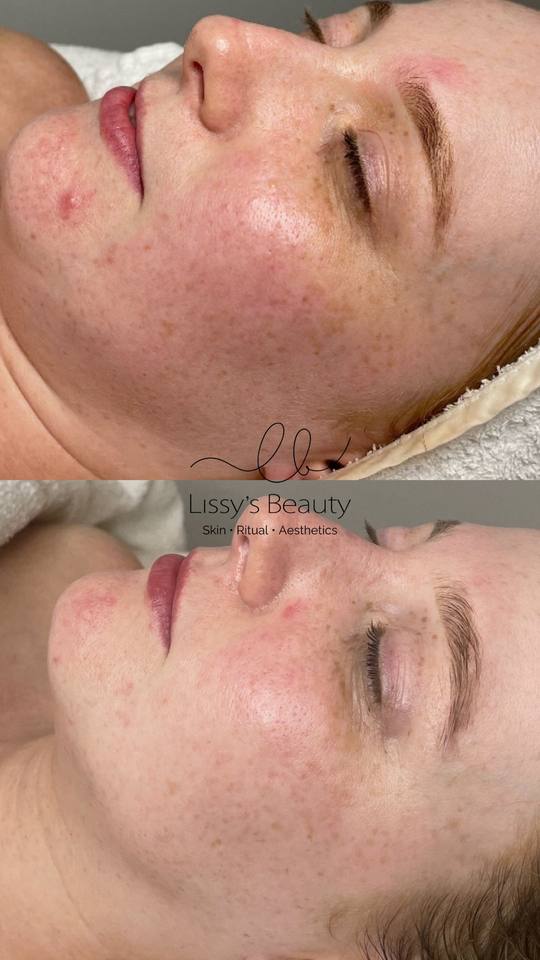 Client skin progress 11