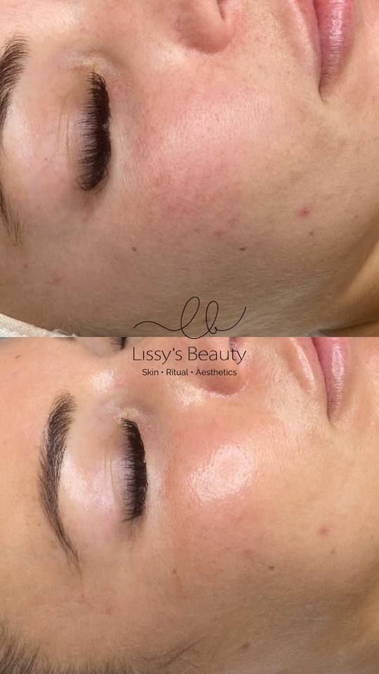 Client skin progress 2