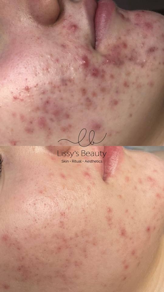 Client skin progress 6