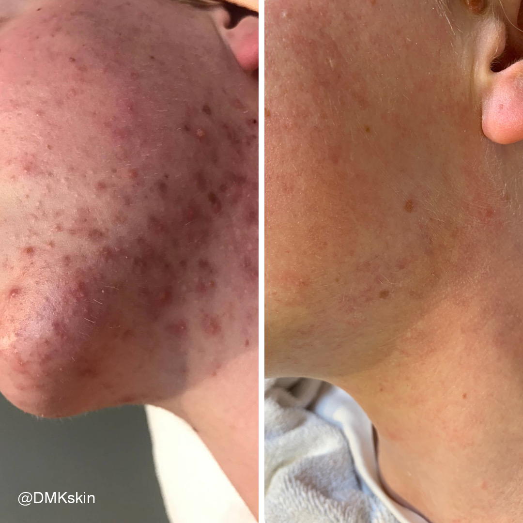 Before and after DMK Enzyme Therapy result