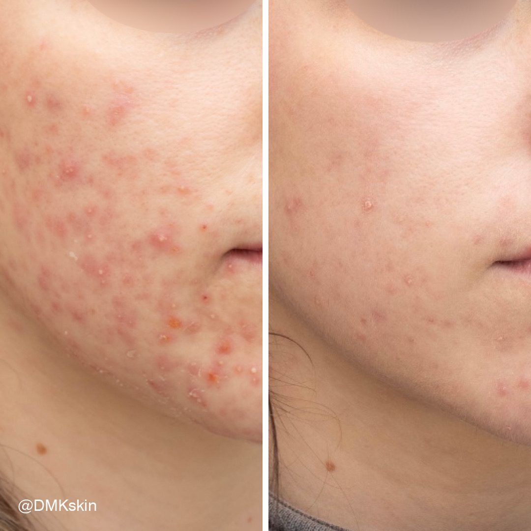Before and after DMK Enzyme Therapy result