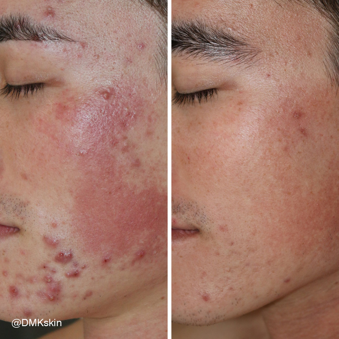 Before and after DMK Enzyme Therapy result