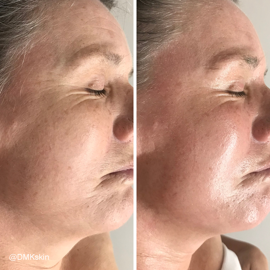 Before and after DMK Enzyme Therapy result