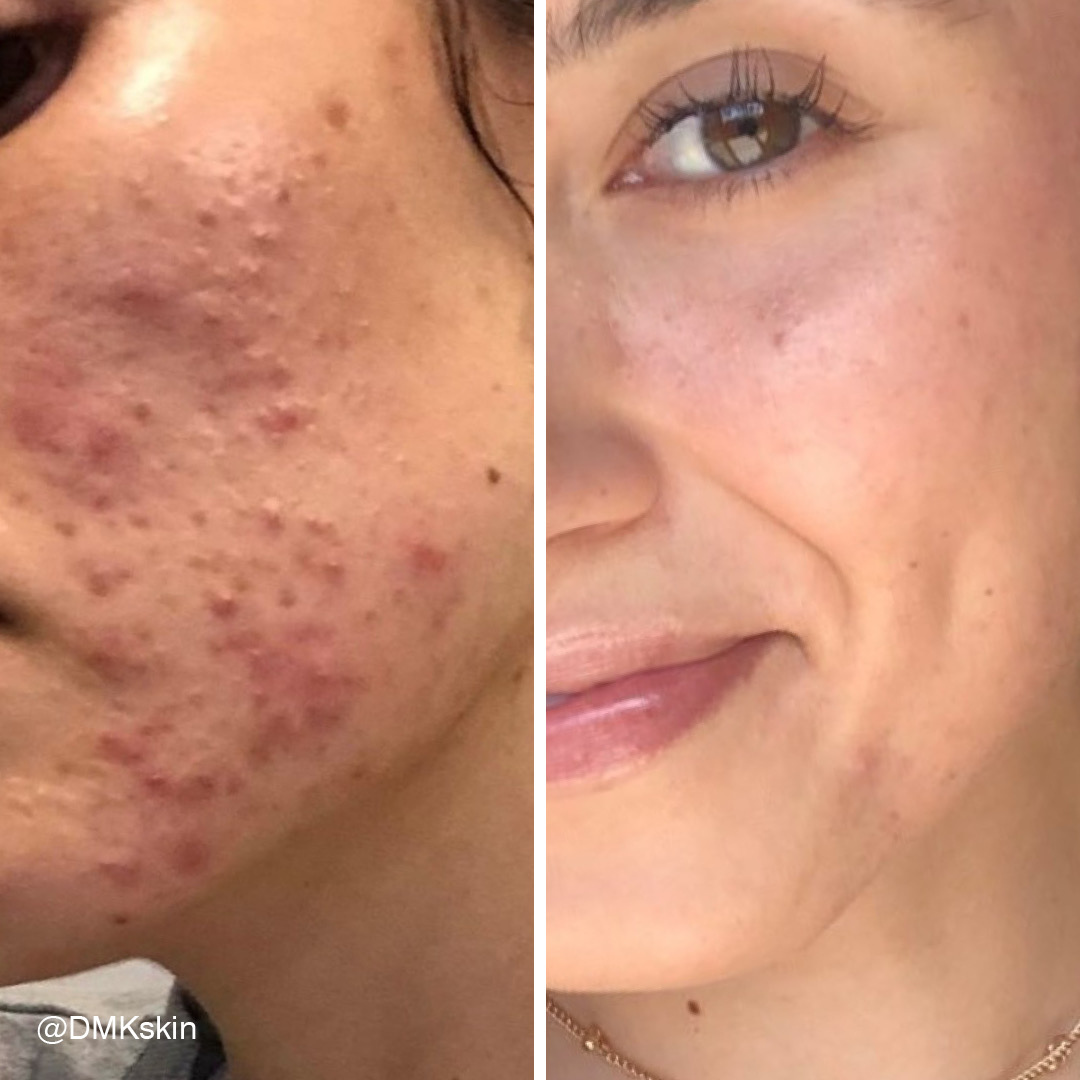 Before and after DMK Enzyme Therapy result