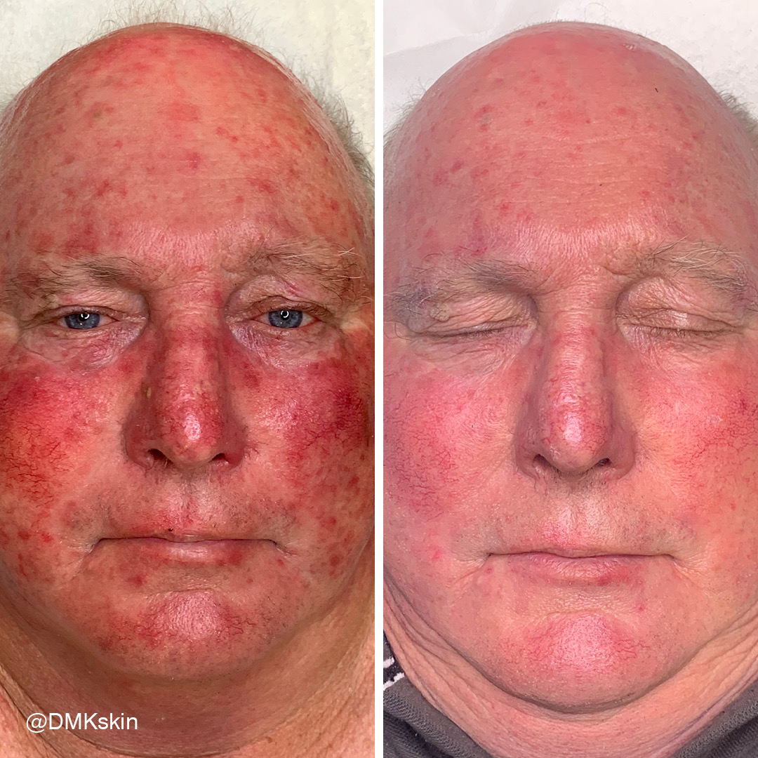 Before and after DMK Enzyme Therapy result