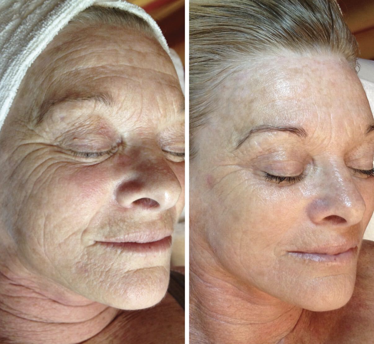 Before and after DMK Enzyme Therapy result