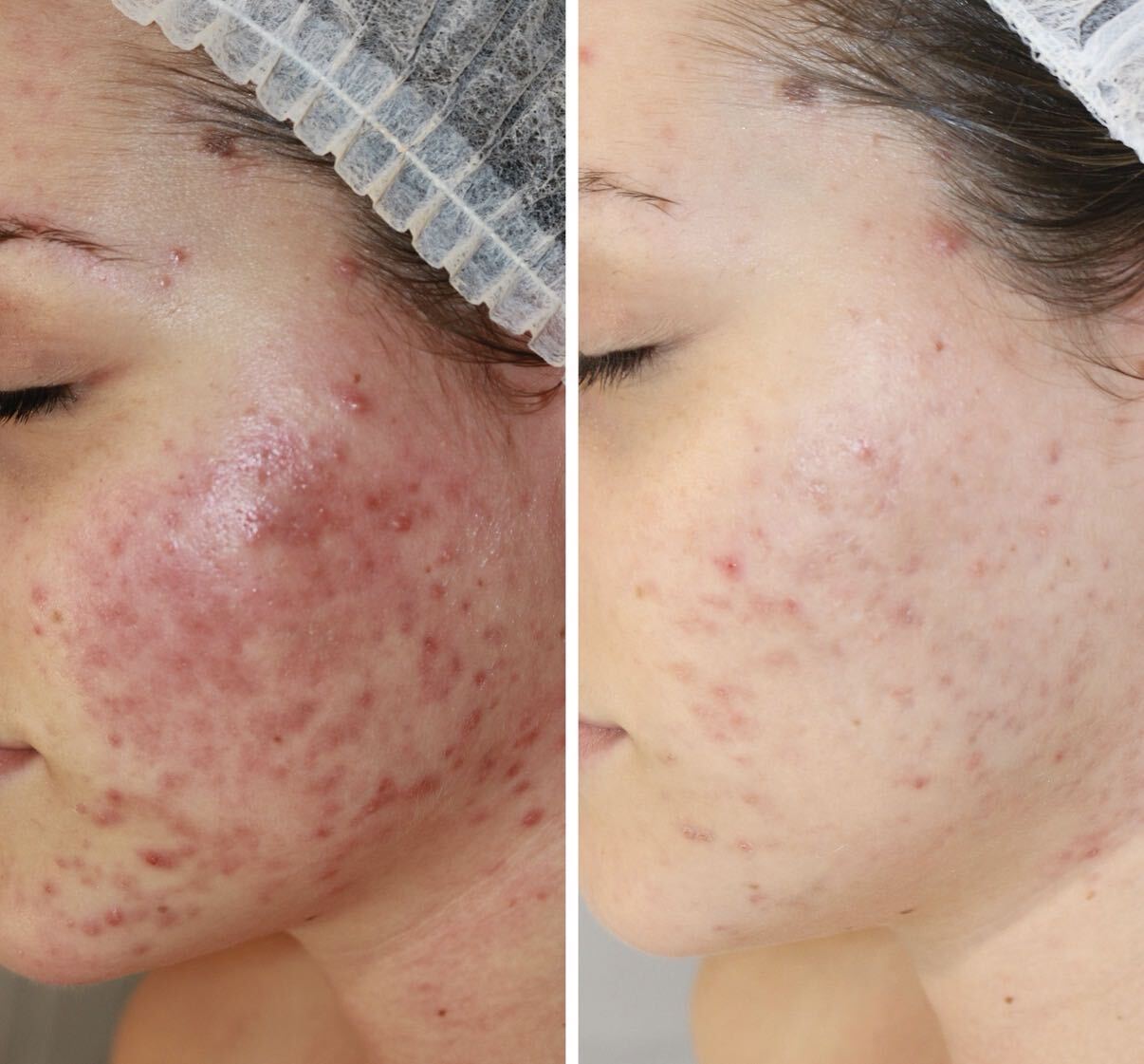 Before and after DMK Enzyme Therapy result