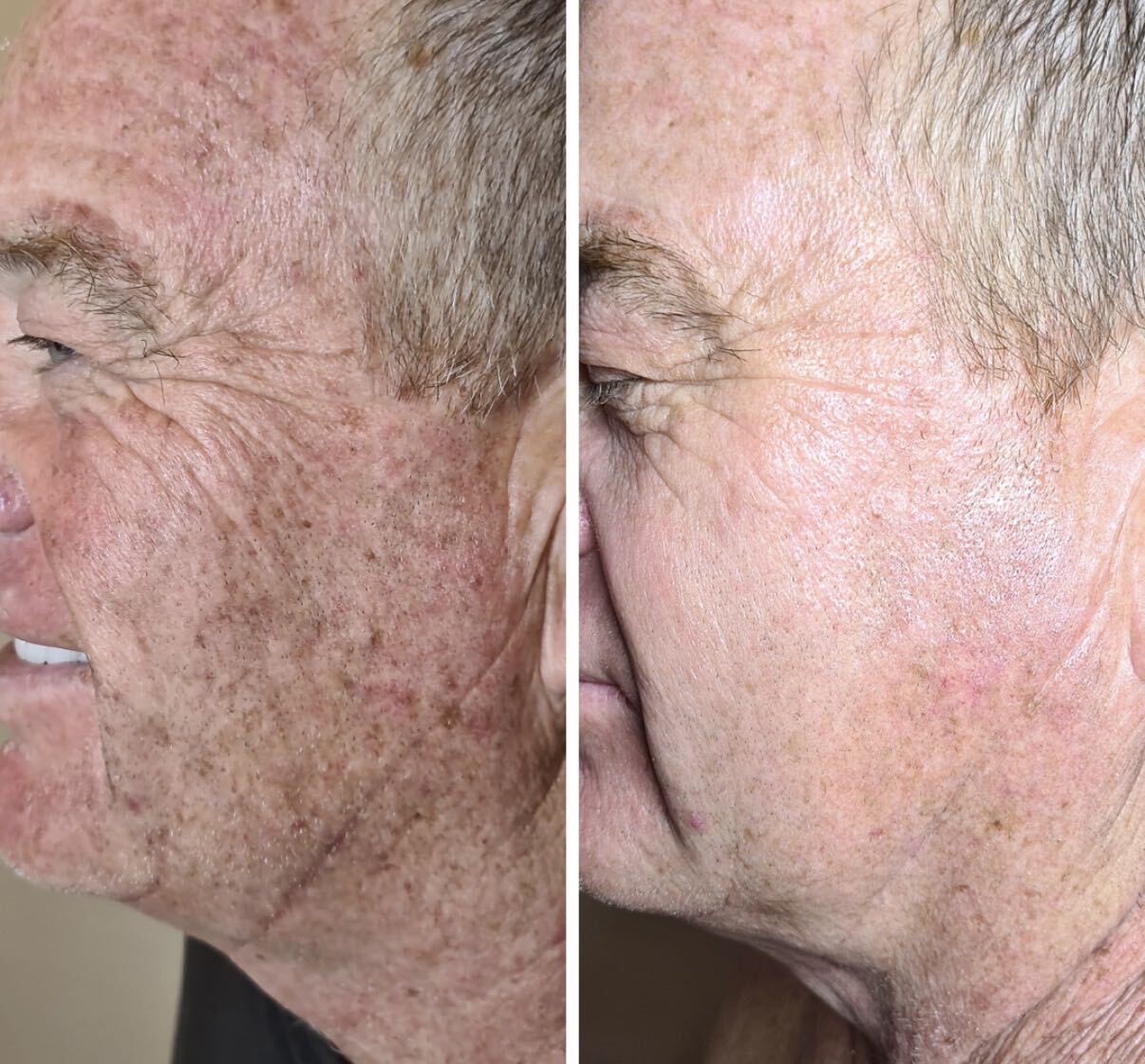 Before and after DMK Enzyme Therapy result