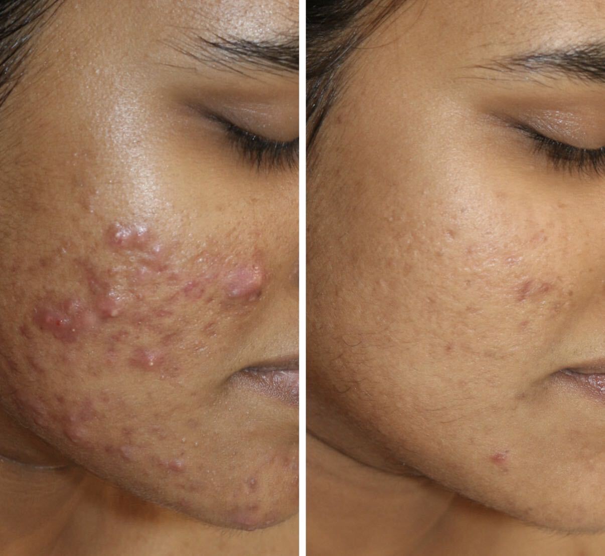 Before and after DMK Enzyme Therapy result