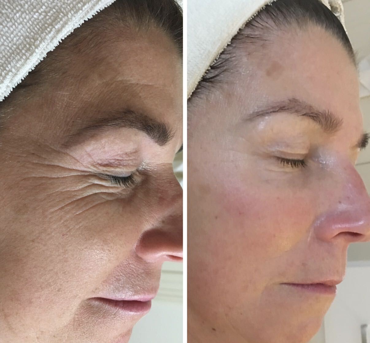 Before and after DMK Enzyme Therapy result