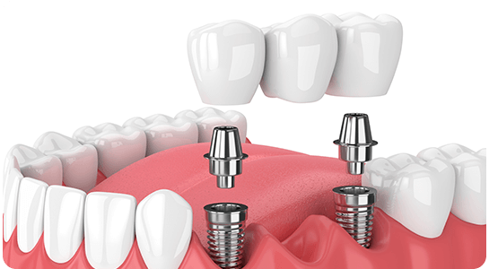 Dental Implants