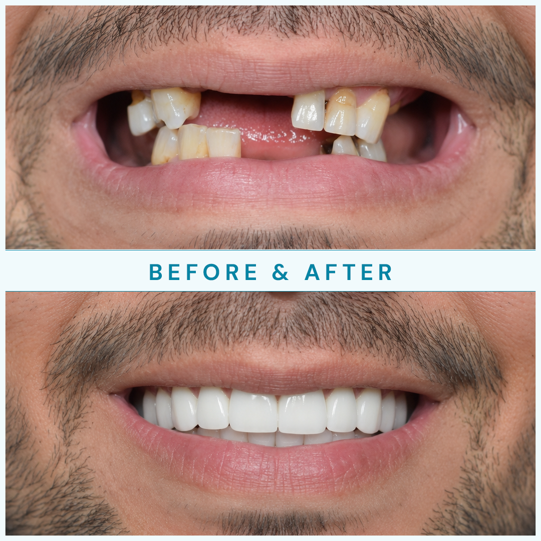 Before and after full-arch restoration