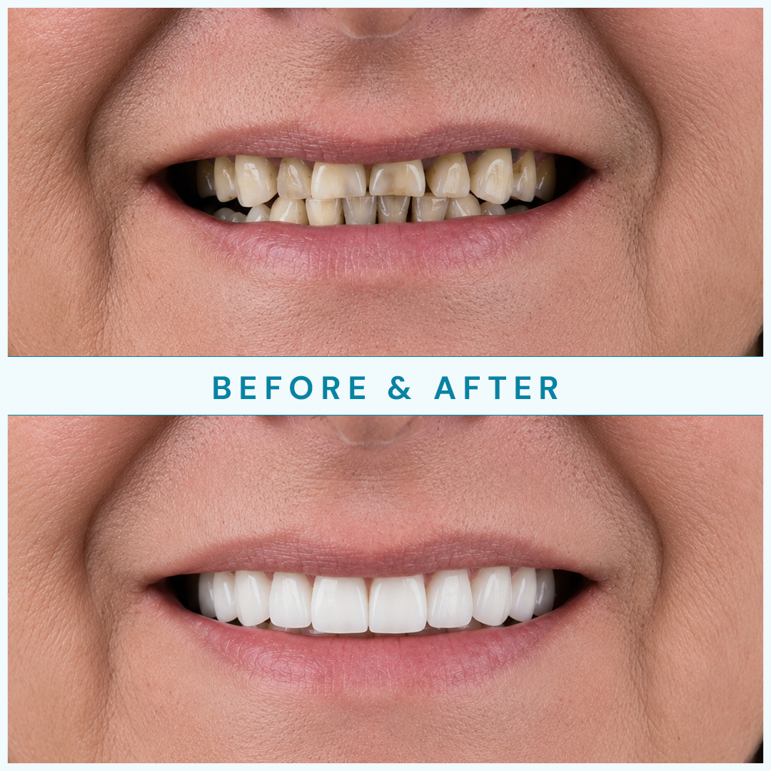Before and after full-arch restoration