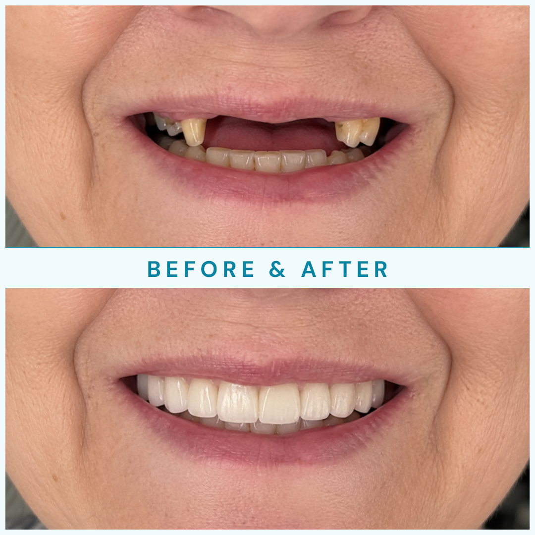 Before and after full-arch restoration