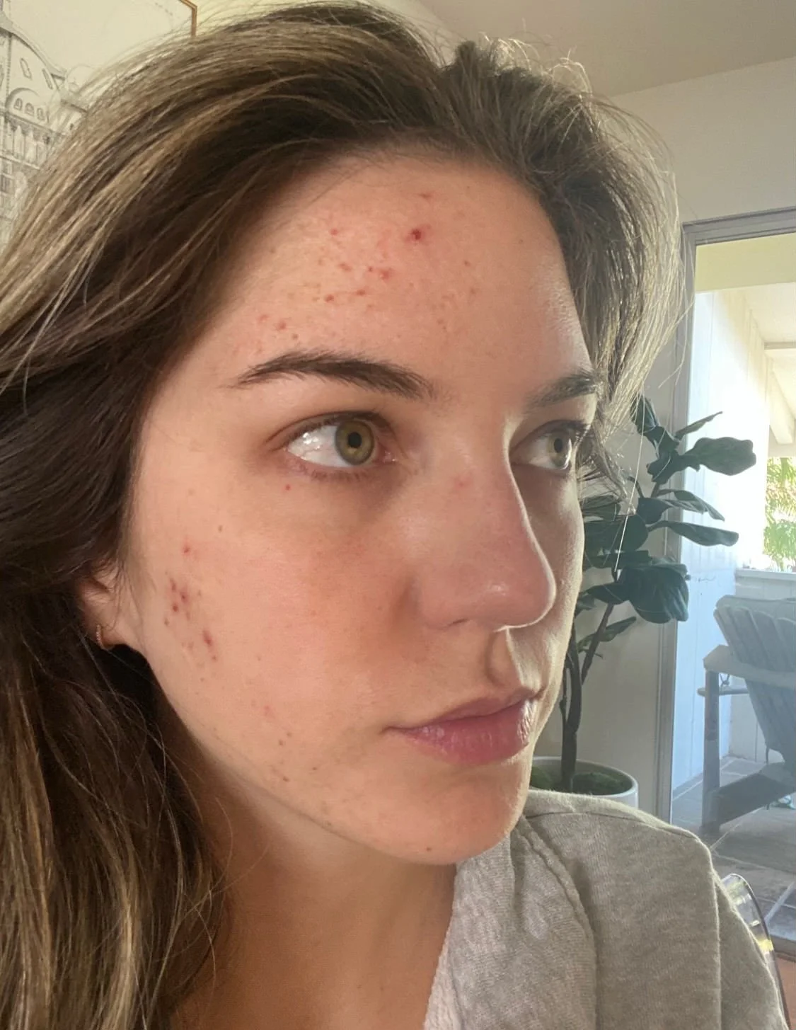 Delaney's skin, before