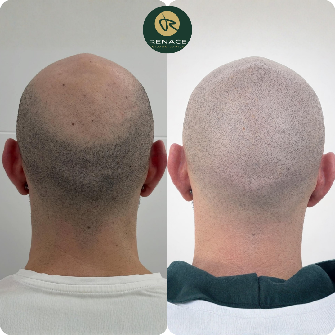 Antes y después micropigmentación capilar — caso real 8