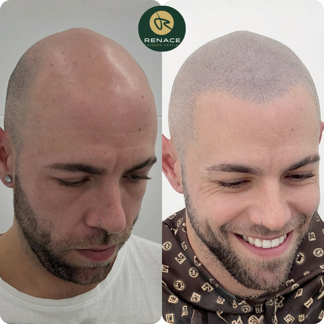 Antes y después micropigmentación capilar — caso real 1