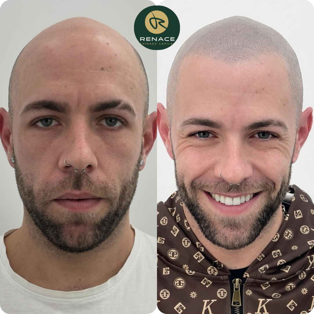 Antes y después micropigmentación capilar — caso real 6