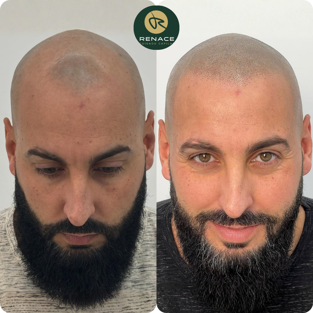 Antes y después micropigmentación capilar — caso real 3