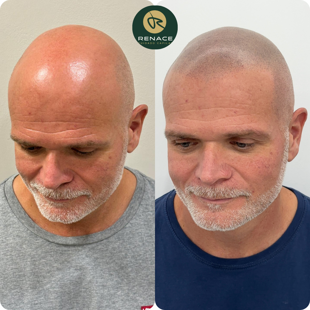 Antes y después micropigmentación capilar — caso real 7
