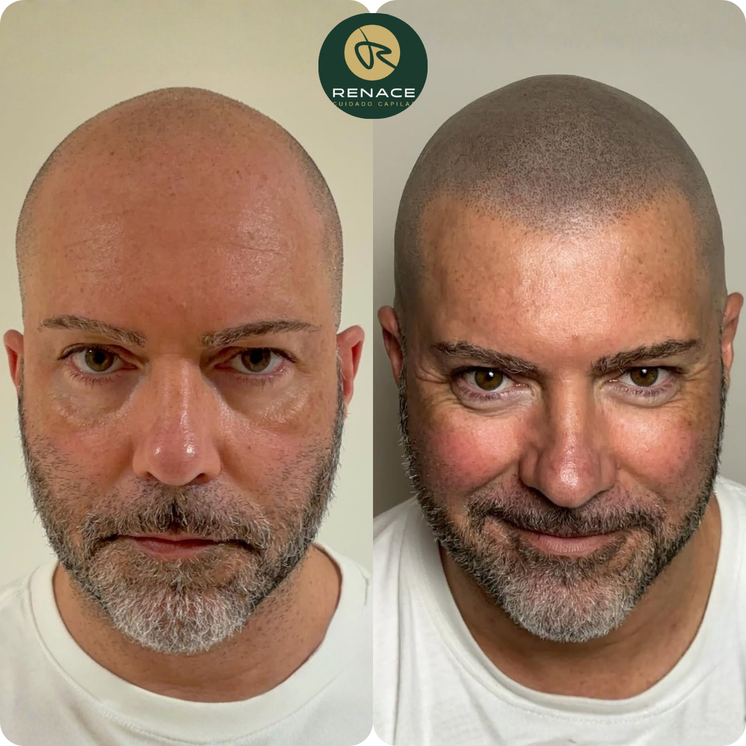 Antes y después micropigmentación capilar — caso real 4