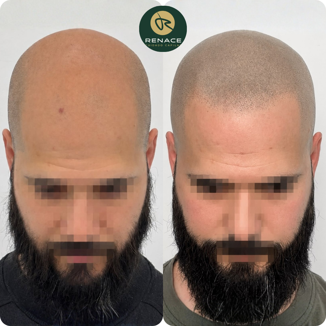 Antes y después micropigmentación capilar — caso real 7