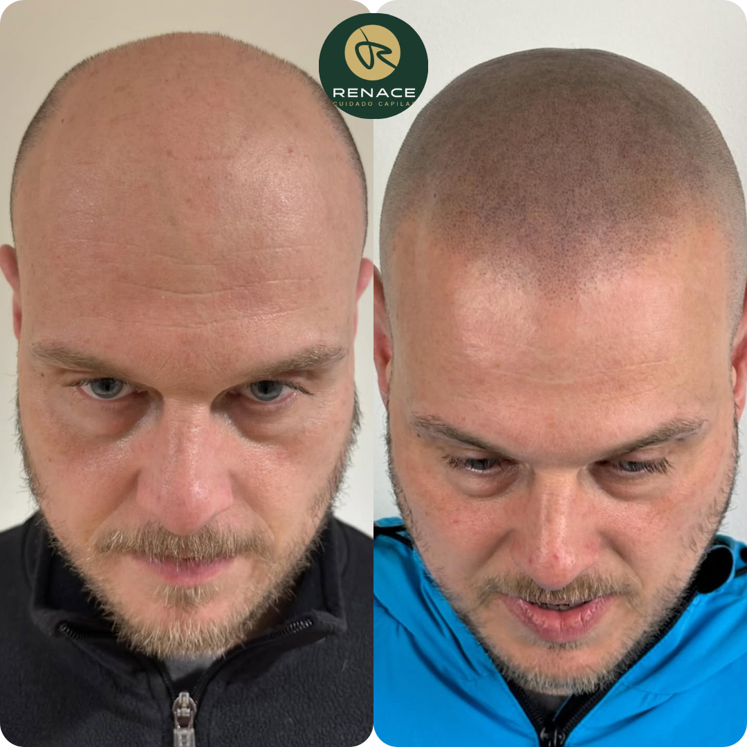 Antes y después micropigmentación capilar — caso real 1